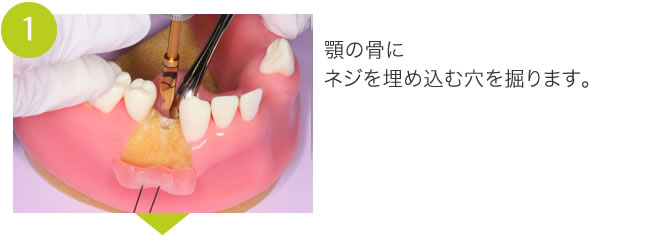 インプラント(1)顎の骨にネジを埋め込む穴を掘ります。