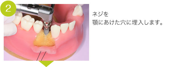 インプラント(2)ネジを顎にあけた穴に埋入します。