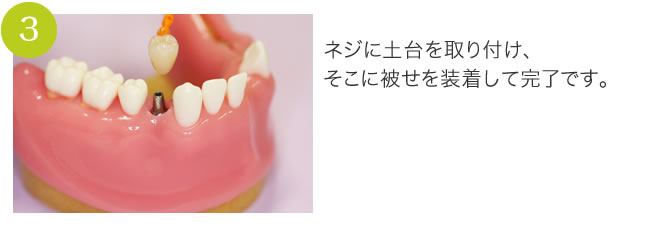 インプラント(3)ネジに土台を取り付け、そこに被せを装着して完了です。